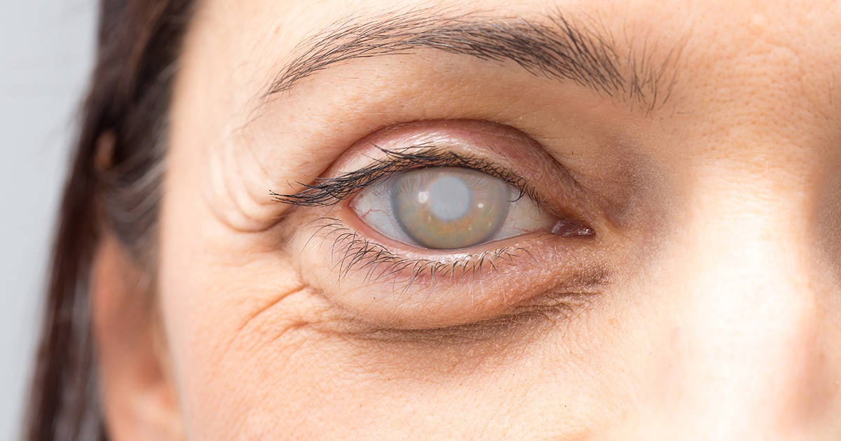 Problems That Occur After Cataract Surgery Daily Nutrition News