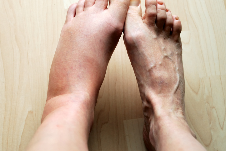 common-causes-of-leg-swelling-daily-nutrition-news