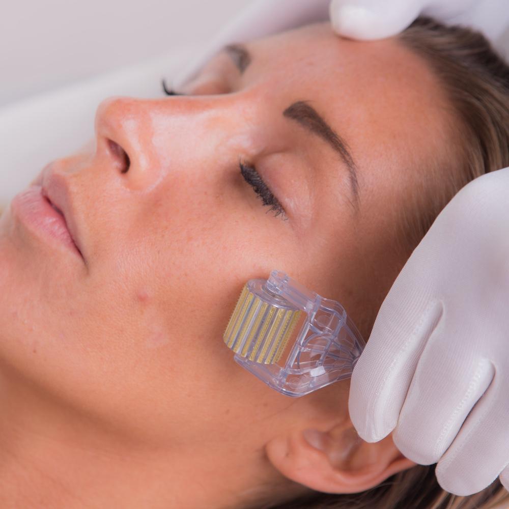 Derma Roller For Acne Scars The Curative Device For Healing Scars Daily Nutrition News 