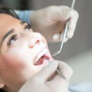 composite fillings