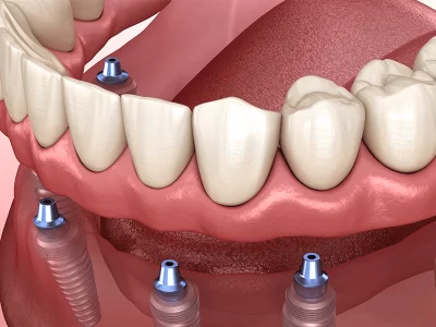 Dental Implants