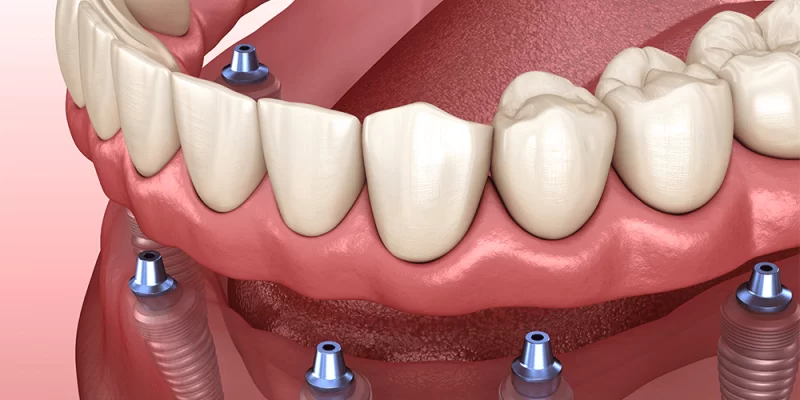 Dental Implants